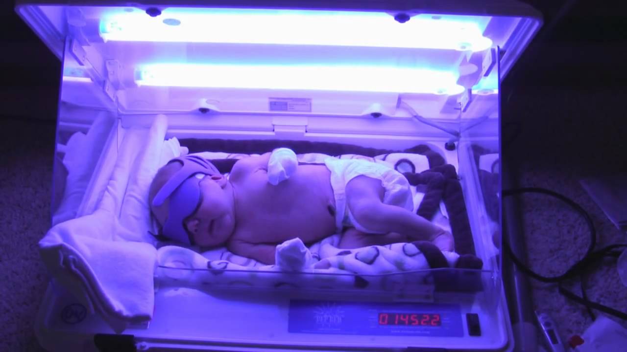 baby-jaundice-phototherapy